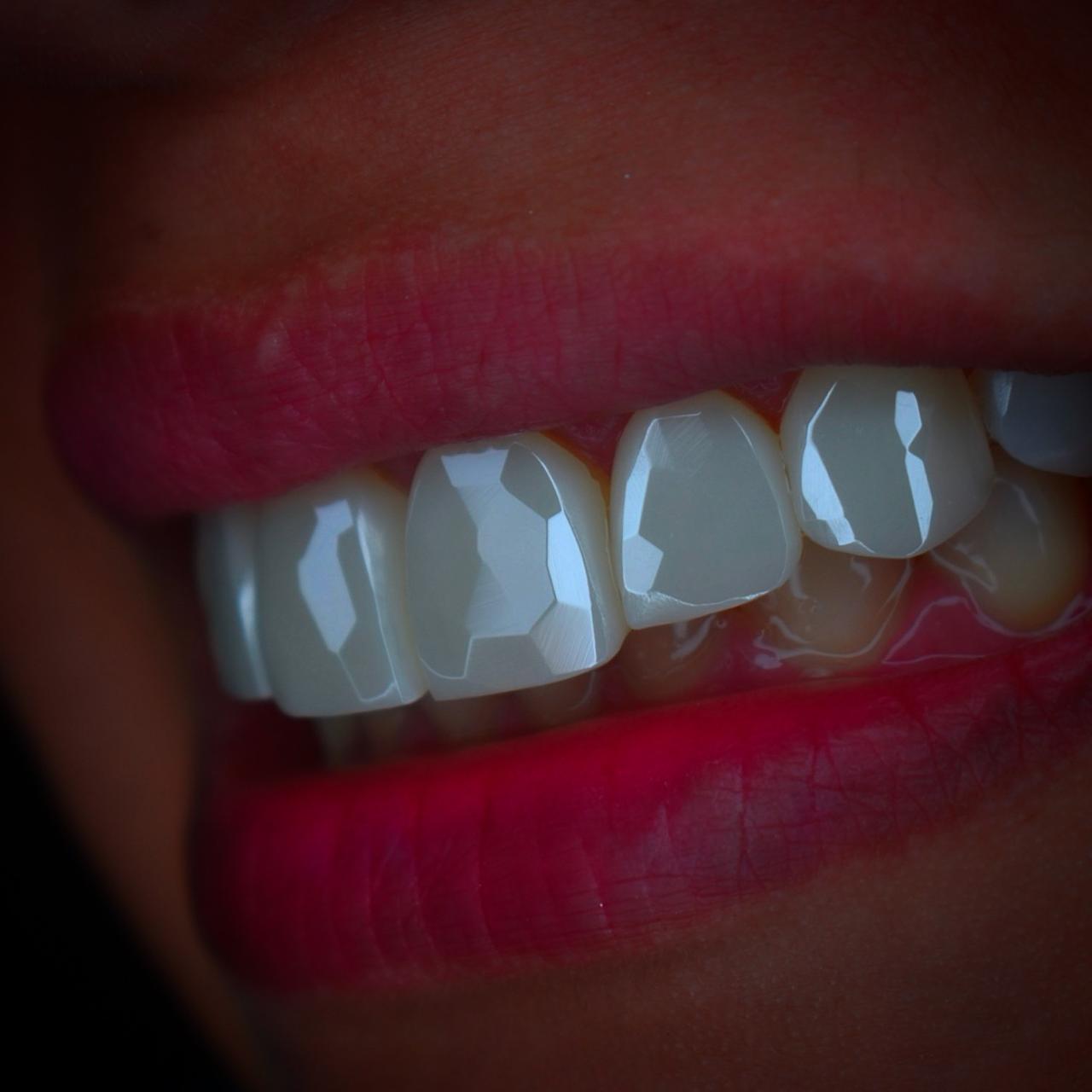 Carillas Diamond Exclusive